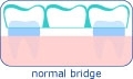 Dental bridge in Hungary