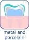 Material for your dental crown in Hungary